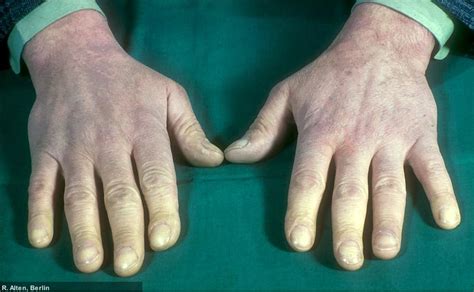 © amanda uhlin | shutterstock.com. Lupus Erythematodes Selbsthilfegruppe Darmstadt