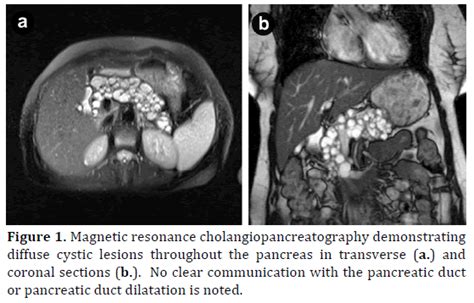 Diffuse Pancreatic Mucinous Cystic Neoplasm Treated By Total Panc