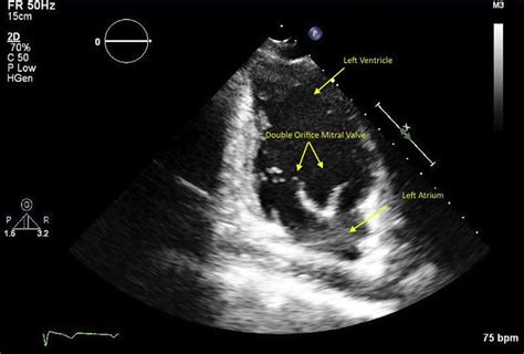 Transthoracic Echocardiography Apical Chamber View A Patient With My
