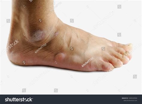 Man Has Dry Skin On Him Stock Photo 1099520504 Shutterstock