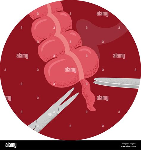 Illustration Of Appendectomy Surgery Removing The Appendix With