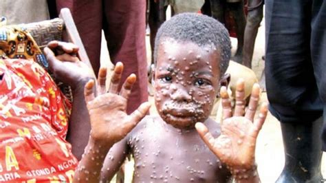 Monkeypox is relatively rare viral zoonosis caused by monkeypox virus that transmits to human body from the infected animal's body, making them ill. Monkeypox: Causes, Symptoms, Diagnosis, Treatment