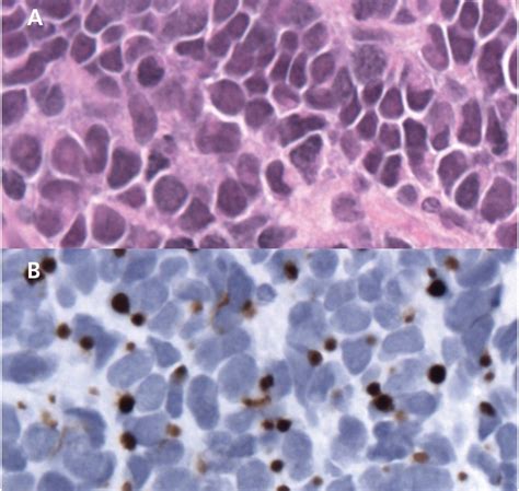 Keytruda may help shrink advanced merkel cell carcinoma (a type of skin cancer). Milestones in the Staging, Classification, and Biology of Merkel Cell Carcinoma in: Journal of ...