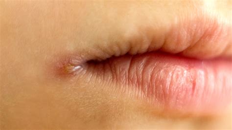 Angular Cheilitis How To Spot And Treat This Dry Lip Condition Goodrx