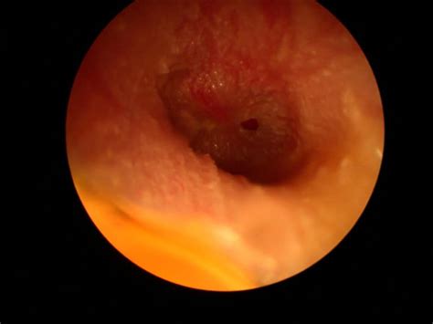 Tympanic Membrane Perforation Hole In The Ear Drum Sydney Ent Clinic