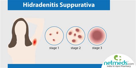 Hidradenitis Suppurativa The Causes Symptoms And Treatment Of Acne