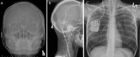 Functional Mri Safety And Artifacts During Deep Brain Stimulation