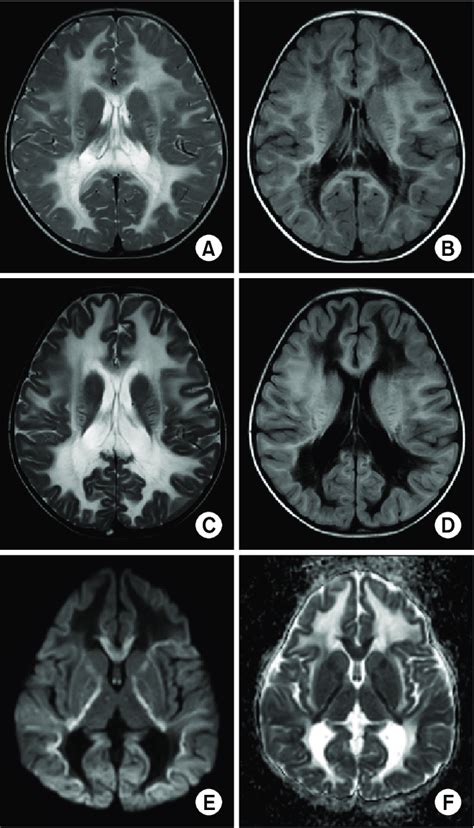 Magnetic Resonance Imaging Of Brain At The Patients 20 Months Old A Download Scientific
