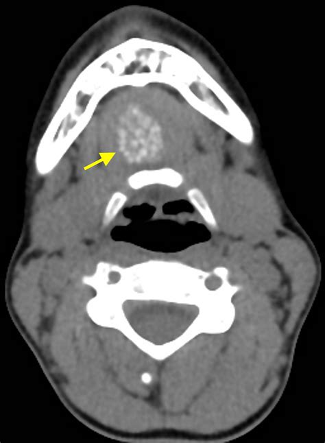 Cureus Dermoid Cyst Of The Floor Of The Mouth Diagnostic Imaging