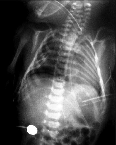 Chest X Ray Showing Right Sided Pneumothorax With Mediastinal Shift