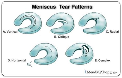 Meniscus Tear Wiki Meniscus Tear Knee Mri Knee Injury Recovery