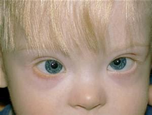 Some infants with down syndrome have eye problems such as cataracts (cloudy lenses) or crossed eyes (strabismus). Down Syndrome (Trisomy 21) - American Academy of Ophthalmology