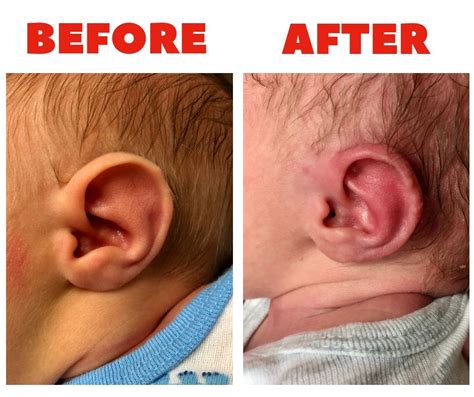 Earlobe Deformities In Newborn Children Are Amenable To Non Surgical