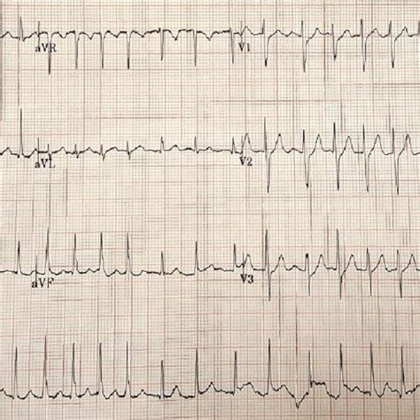 A 12 Lead Electrocardiogram Of The Patient Showing Atrial Fibrillation