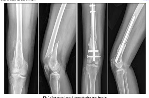 Pdf Functional Outcomes Of Retrograde Femoral Nailing In Extra