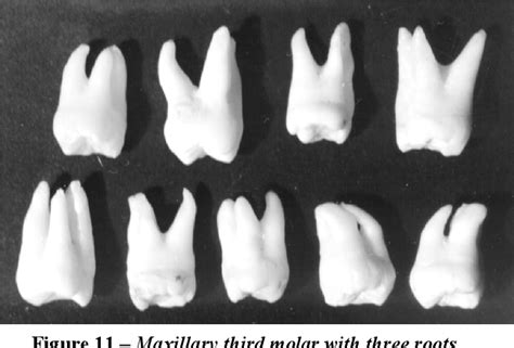 Figure 11 From Morphological Study Of Upper Wisdom Tooth Semantic