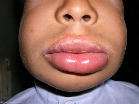 angioedema of the lips pictures