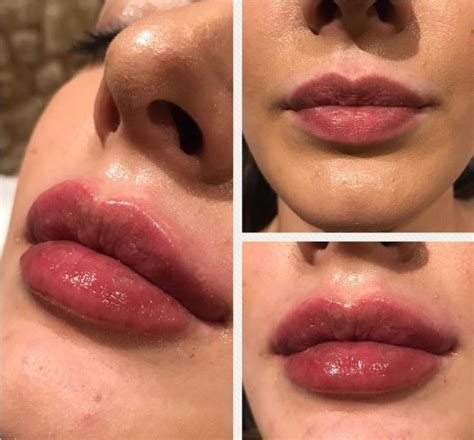 How Long Do Your Lips Stay Swollen After Injections Lip Fillers