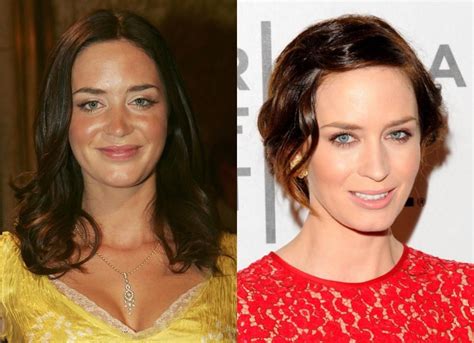 Celebrity Plastic Surgery Before And After Pics Celebrity Plastic