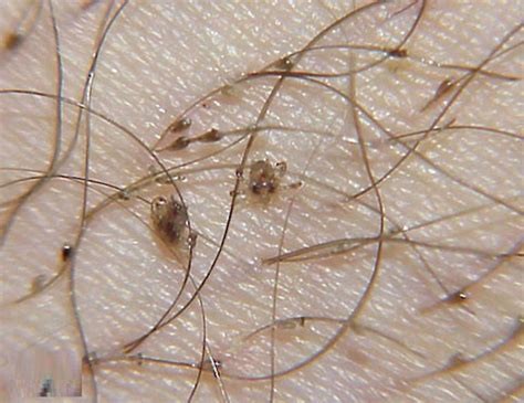 Pubic Lice Or Crab Lice Signs Symptoms Transmission Pubic Lice