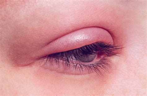 Eyelid Infection Types And Treatment