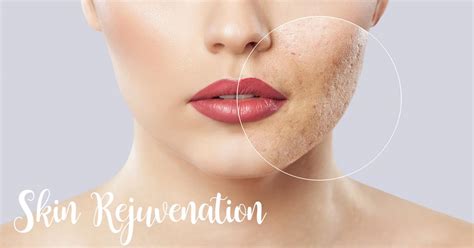 Laser Skin Rejuvenation Sun Spots Acne Derick Dermatology