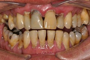 Smoking and gum disease | Studio Dentaire