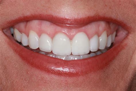 Smile Touch Ups Cosmetic Dentistry Paducah Woodyard Dental Care