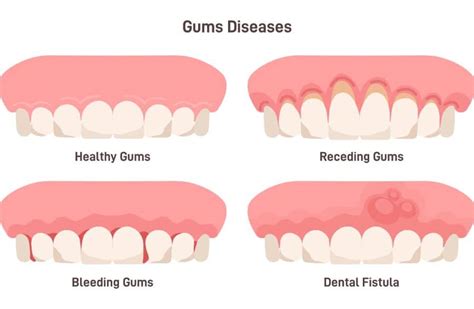 5 Signs You May Have Receding Gums And Treatment Options Lime Light