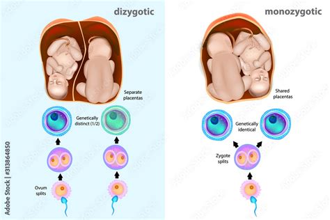 monozygotic or dizygotic twins types of twins stock vector adobe stock