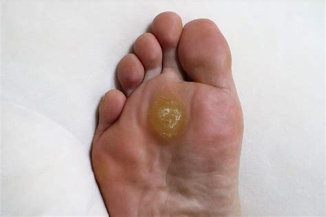 Foot Corn Vs Callus Understanding The Differences Between These Skin