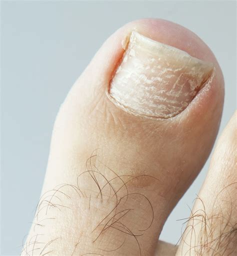 What Are White Lines On Toenails Design Talk