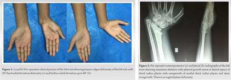 Single Stage Distal Radius Dome Osteotomy With Ulnar Diaphyseal