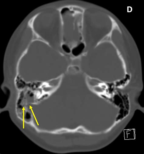 Skull Fracture Diagnosis Mri Online