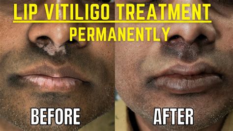 Vitiligo On Lips Lip Leucoderma Permanent Vitiligo Lips Treatment