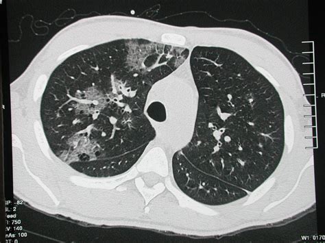 Ct Findings Of Pulmonary Kaposis Sarcoma In A Patient With Aids Eurorad