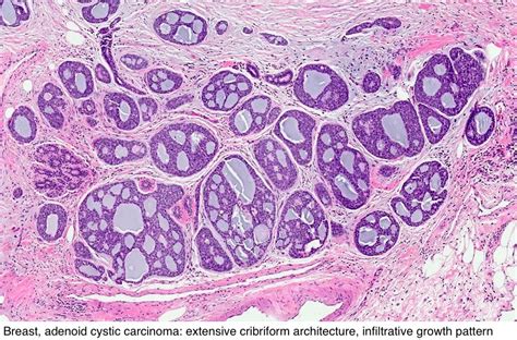 Pathology Outlines Adenoid Cystic