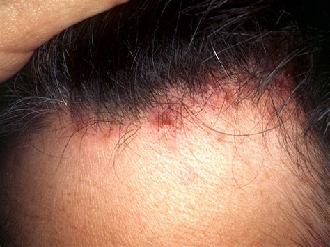What Causes Bumps On Scalp My Xxx Hot Girl