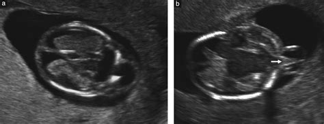 Sonographic Spectrum Of First‐trimester Fetal Cephalocele Review Of 35