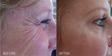 Rewind Time With Crows Feet Treatments Real You Clinic Twickenham