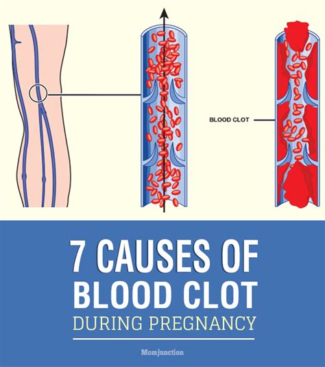 List 103 Pictures Photos Of Blood Clots Updated