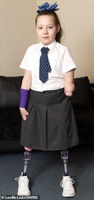 Schoolgirl Who Lost Legs And Left Arm To Meningitis Is Chuffed To Bits With Bionic Hero Hand