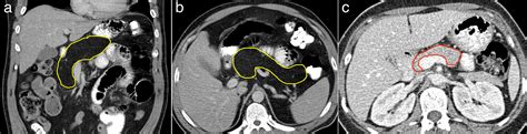 Primary secretory products normal secondary modification is impaired. Pancreatic lipomatosis in cystic fibrosis - CT - Radiology ...