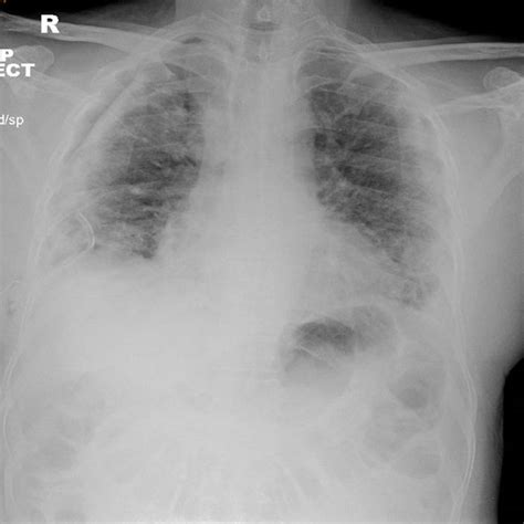 Pdf Spontaneous Tension Pneumothorax And Acute Pulmonary Emboli In A