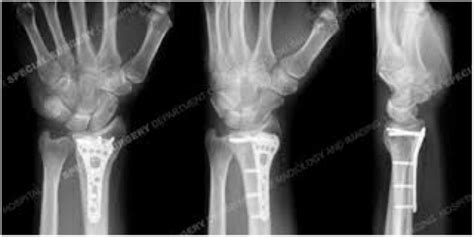 Distal Radius Fracture Repair Includes Implants St