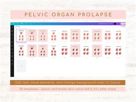 Types Of Pelvic Organ Prolapse Rectocele Stages Cystocele Etsy UK