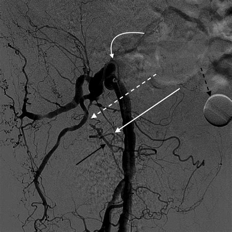 Selective Angiogram Of The Right Internal Iliac Artery Curved Arrow