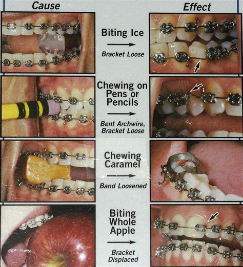Saat dicek ke dokter, tak jarang dokter rontgen gigi akan memudahkan untuk menemukan apa sebenarnya permasalahan yang terjadi pada gigi anda. s!x_stOne: Braces vs GIGI BESI part 1