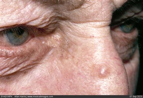 Stock Image Dermatology Basal Cell Carcinoma A Rounded Raised Lesion