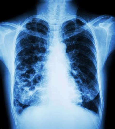 Chronic Bronchitis Chest X Ray Sexiz Pix